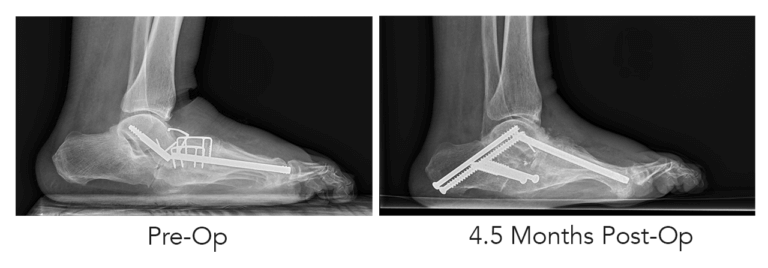 A 60-year-old man, diagnosed with midfoot Charcot arthropathy, with a history of unsuccessful surgery and hardware failure, underwent a corrective procedure. The revision involved fusion of the medial column using the DynaNail Mini® Fusion System and bone allograft.
