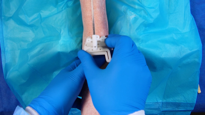 Star Ankle procedure - Lundeen