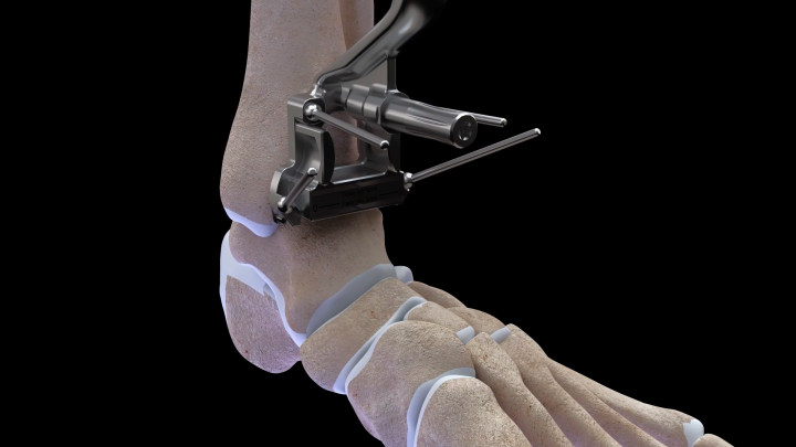 Airlock Ankle Fusion - Surgical Technique Guide Animation