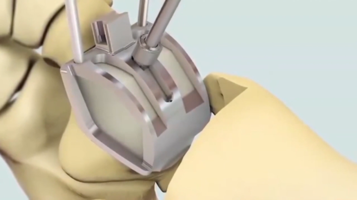 STAR Animated Surgical Technique