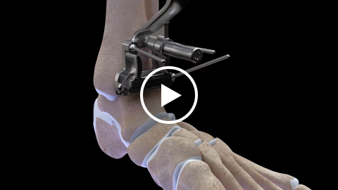 Airlock Ankle Fusion - Surgical Technique Guide Animation