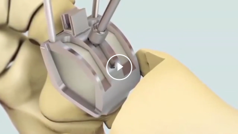 STAR Animated Surgical Technique